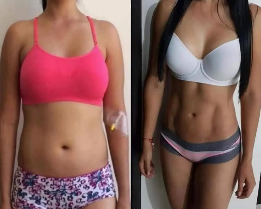 Resultados Slim Láser