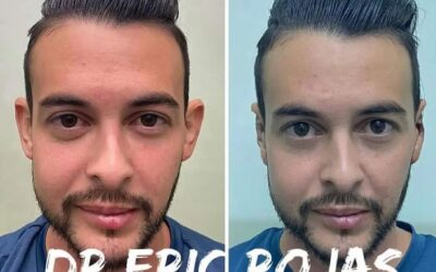 Otoplastía