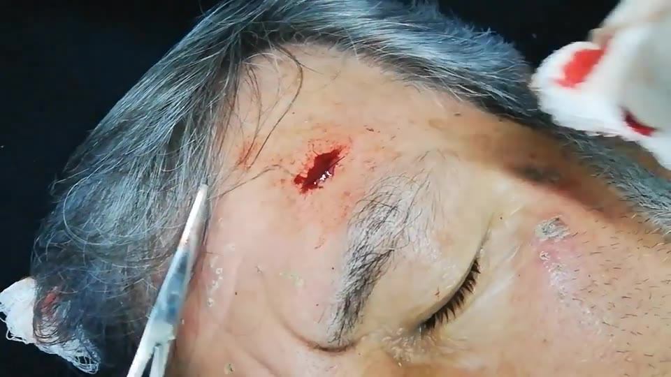 El carcinoma basocelular suele aparecer en la forma de un bulto ligeramente transparente en la piel