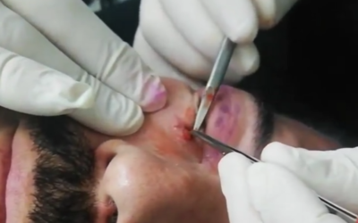 Blefaroplastia DERMATOLÓGICA SOLO PIEL Y MEJORA TUS PÁRPADOS
