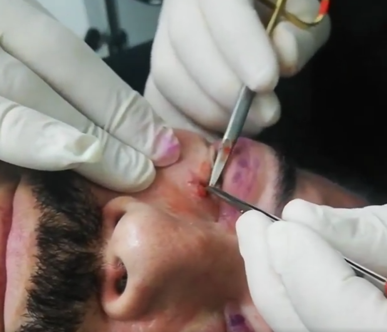 Blefaroplastia DERMATOLÓGICA SOLO PIEL Y MEJORA TUS PÁRPADOS