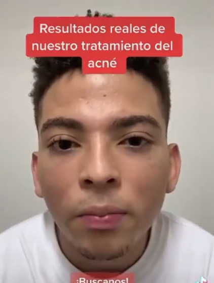 Resultados reales de nuestro centro especializado en tratamiento del acn