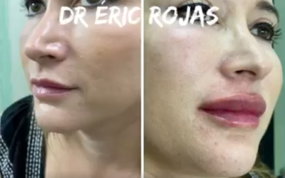 Modelado de LABIOS DR ÉRIC ROJAS 22483535