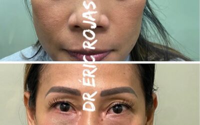 ELIMINACIÓN DE OJERAS