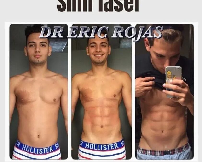 Slim láser con excelentes resultados