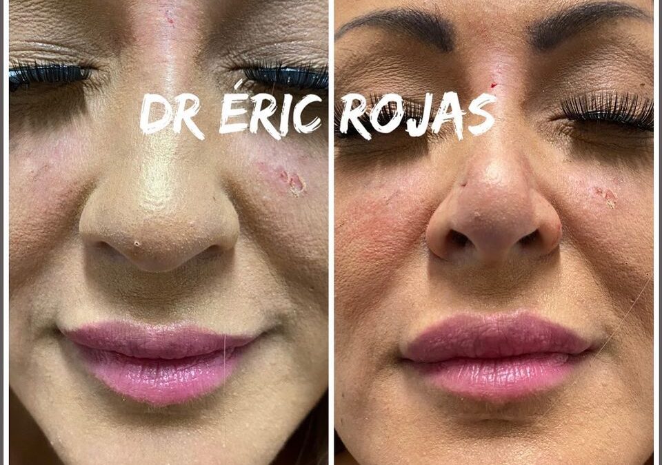 Afinamiento DE PUNTA NAZAL