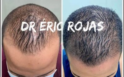 Recuperar su cabello es posible