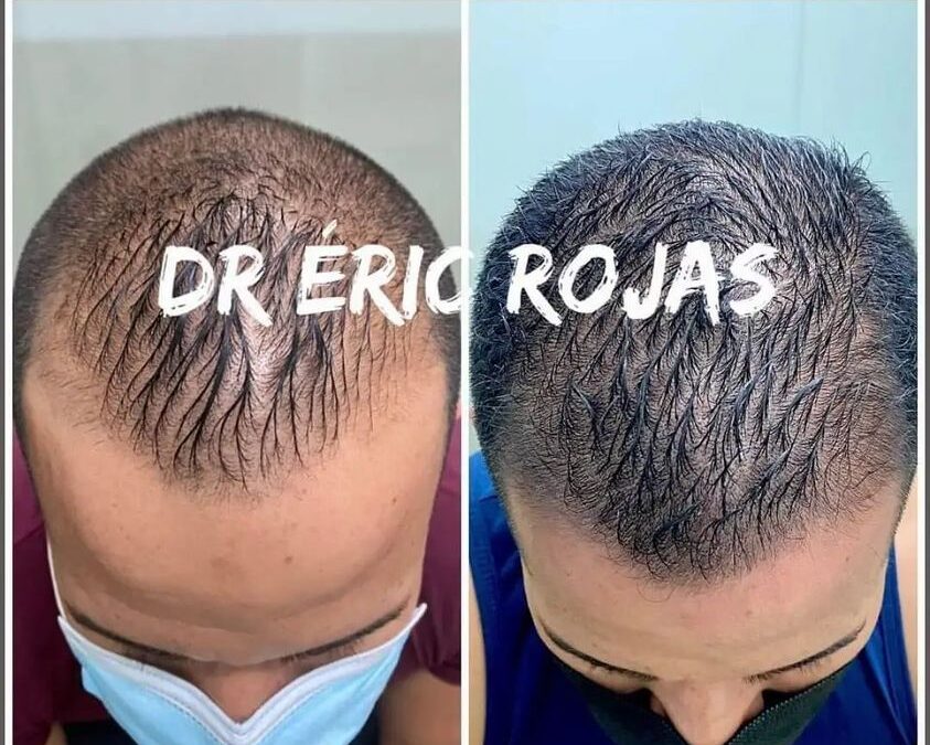 Recuperar su cabello es posible