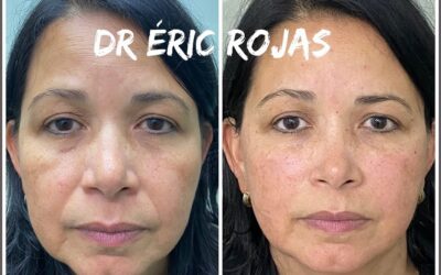 Refrescamiento FACIAL