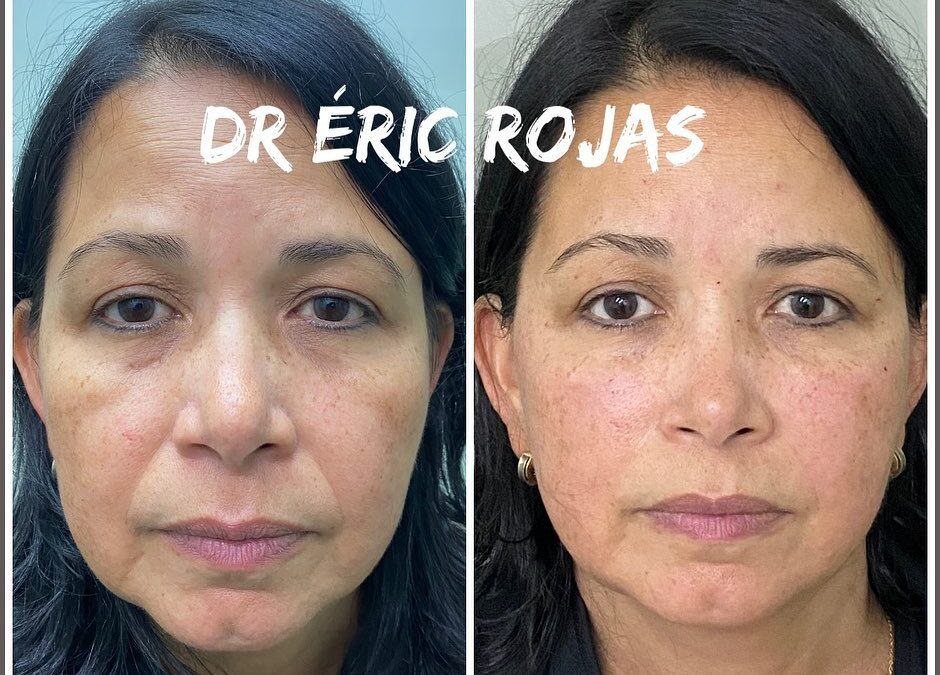 Refrescamiento FACIAL