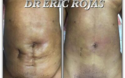 Cesárea, cicatriz de apendicectomía, además de una liposucción anterio