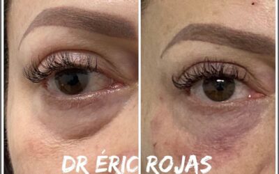 ELIMINACIÓN DE OJERAS DR ÉRIC ROJAS