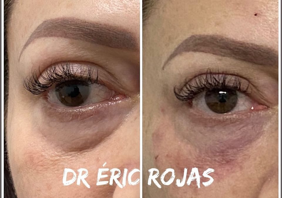 ELIMINACIÓN DE OJERAS DR ÉRIC ROJAS