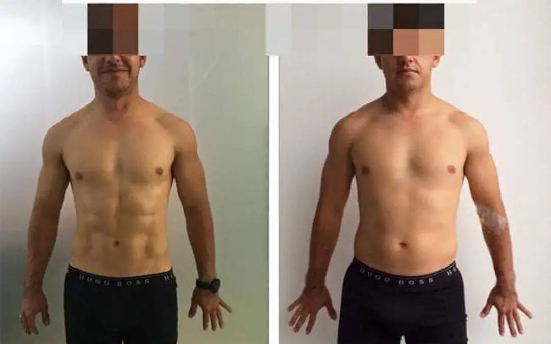 Marcación abdominal