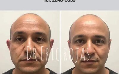 Otoplastía