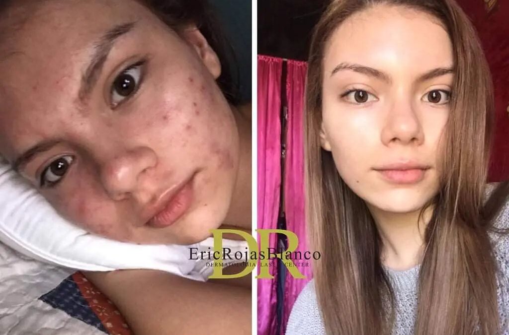 Tratamiento para el acné