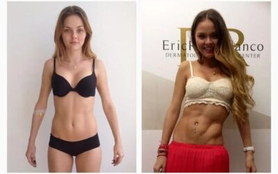 Abdomen Slim Láser
