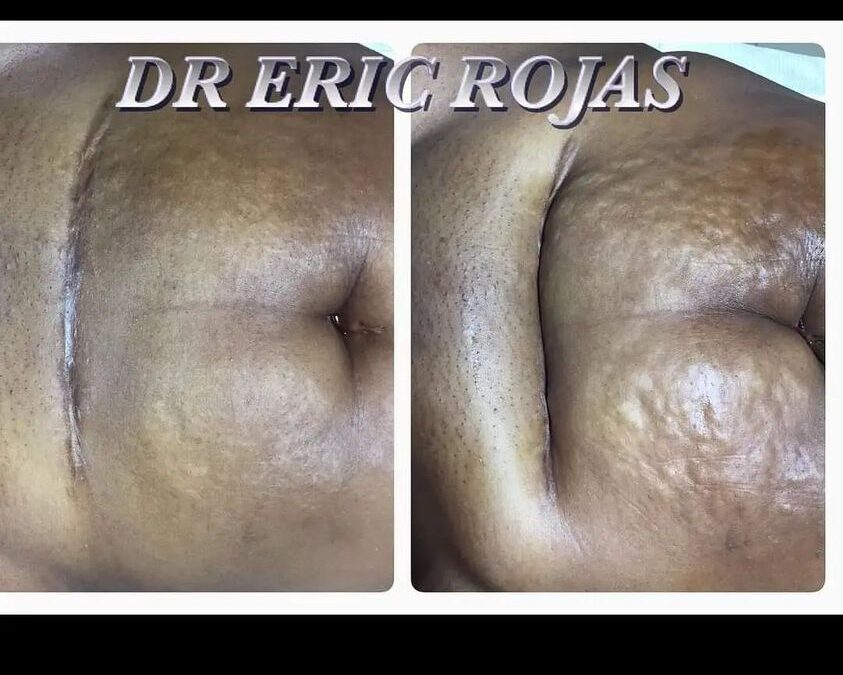 Corrección de cicatrices