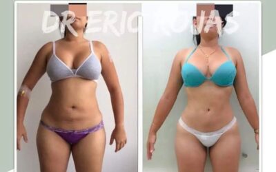 Slim láser en abdomen