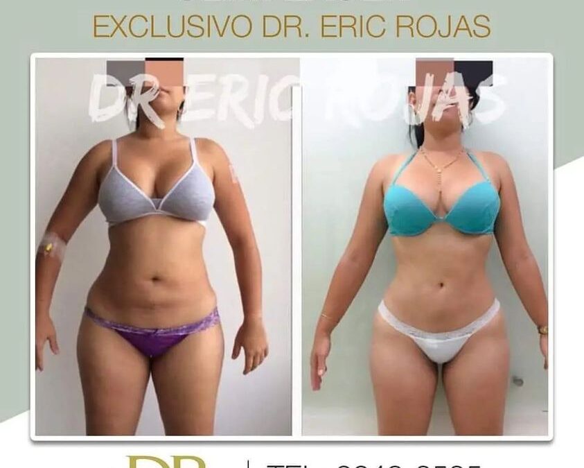 Slim láser en abdomen