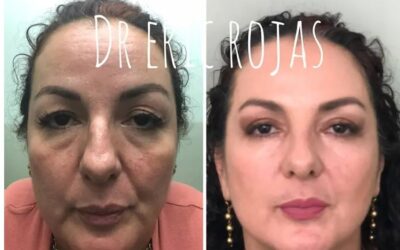 Rejuvenecimiento facial sin cirugía