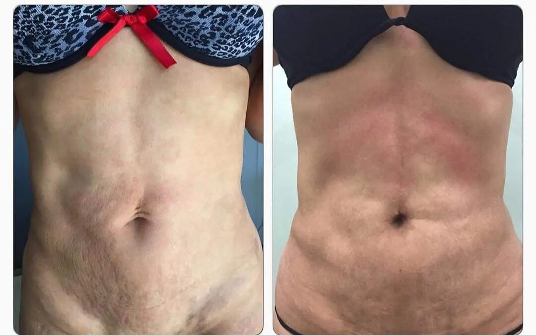 Mejoría de ombligo caído