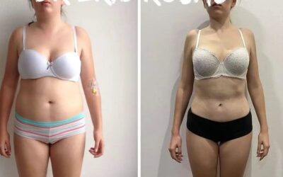 Slim láser con excelentes resultados
