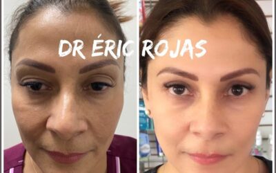 REJUVENECIMIENTO FACIAL