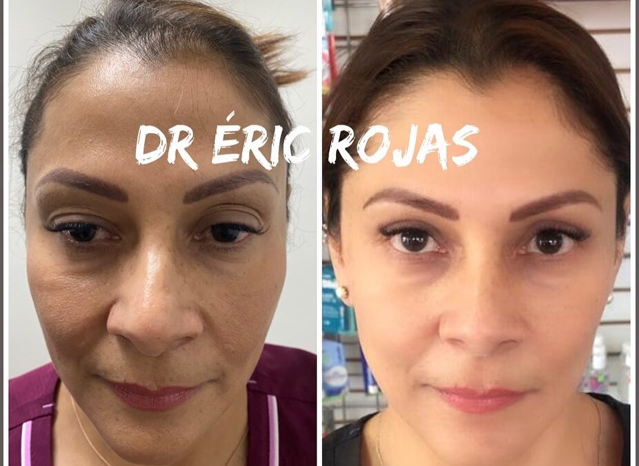 REJUVENECIMIENTO FACIAL