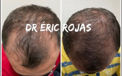 CAÍDA CABELLO YA NOOOO MÁS DR ÉRIC ROJAS 22483535