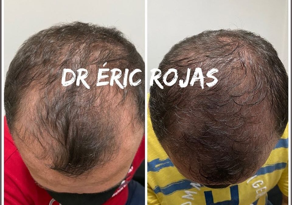 CAÍDA CABELLO YA NOOOO MÁS DR ÉRIC ROJAS 22483535
