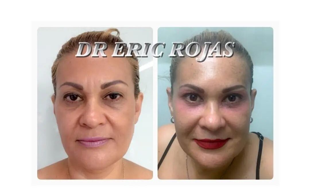 Rejuvenecimiento facial