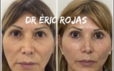 Rejuvenecimiento FACIAL DR ÉRIC ROJAS 22483535