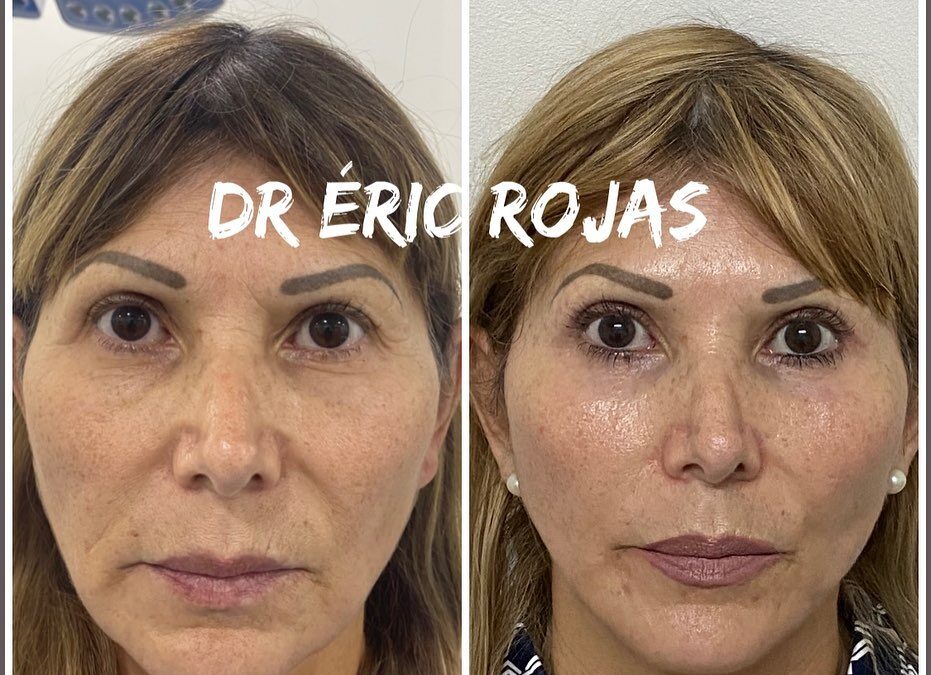 Rejuvenecimiento FACIAL DR ÉRIC ROJAS 22483535