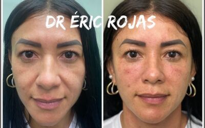 Refrescamiento Facial