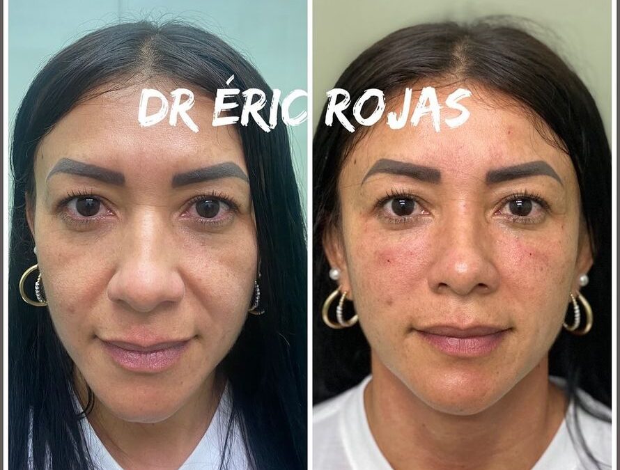 Refrescamiento Facial