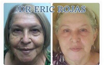 Rejuvenecimiento facial sin cirugía