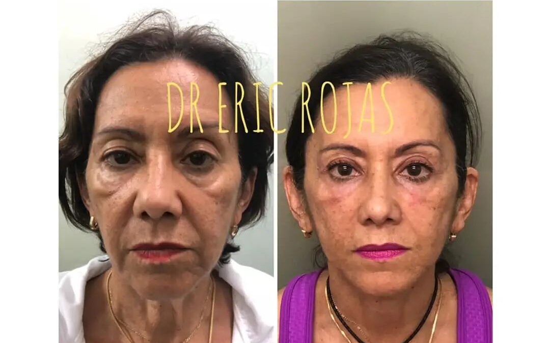 Rejuvenecimiento facial ¡Agenda tu cita ya!  ☎️ 2248-3535  📲 6405-3535