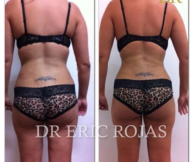 Resultados increíbles slim láser