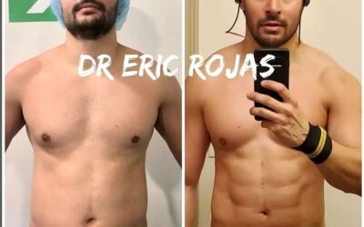 Excelentes resultados de slim láser en nuestro paciente