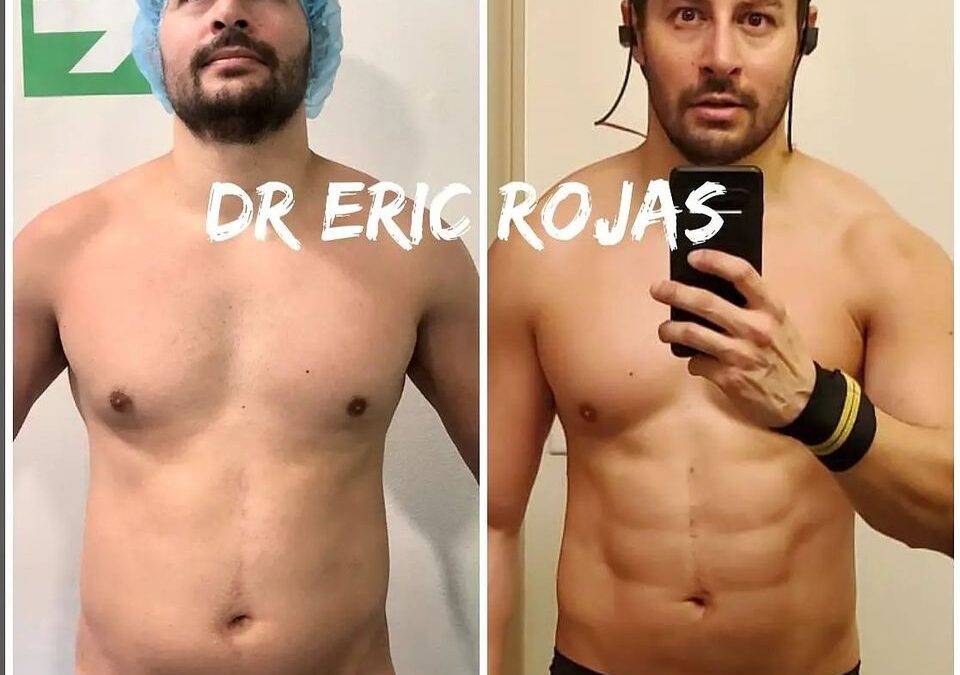 Excelentes resultados de slim láser en nuestro paciente