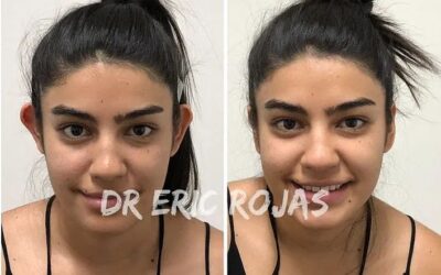 Otoplastía con excelentes resultados