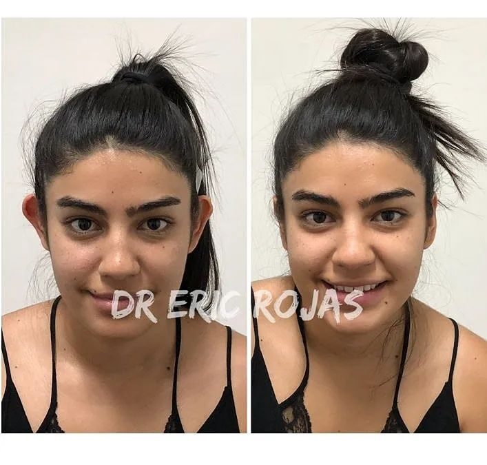 Otoplastía con excelentes resultados