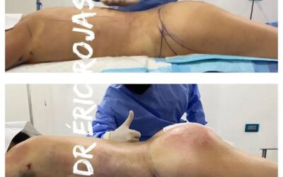 Slim láser y transferencia en glúteos