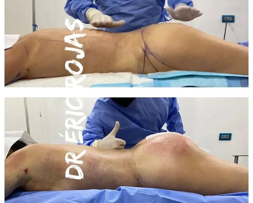 Slim láser y transferencia en glúteos