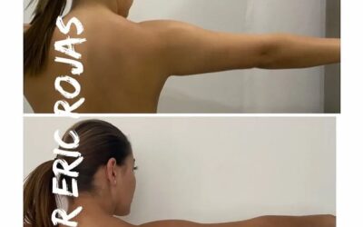 Slim Láser en brazos