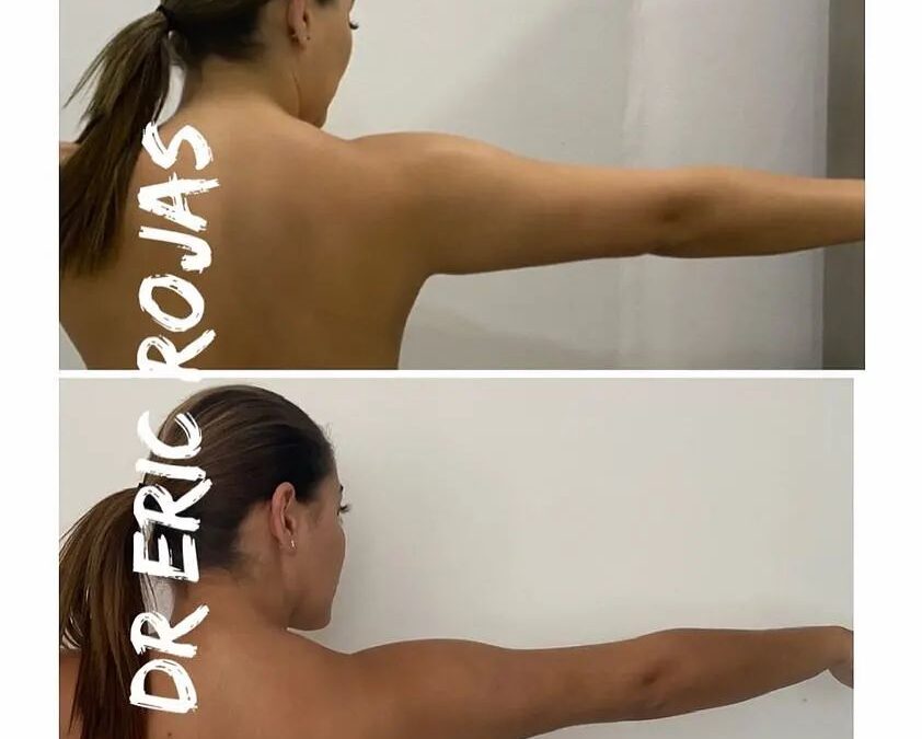 Slim Láser en brazos