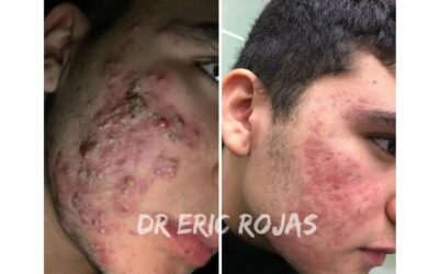 Tenemos el tratamiento perfecto para el acné