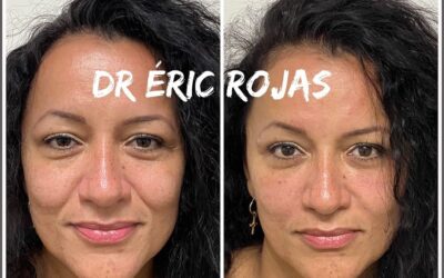 REFRESCAMIENTO FACIAL DR ÉRIC ROJAS 22483535