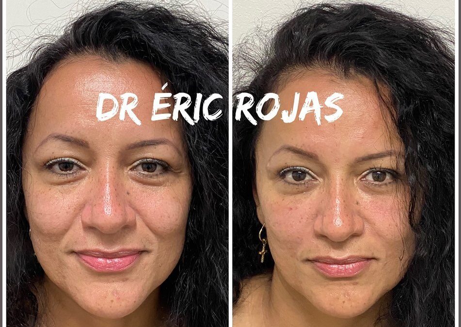 REFRESCAMIENTO FACIAL DR ÉRIC ROJAS 22483535